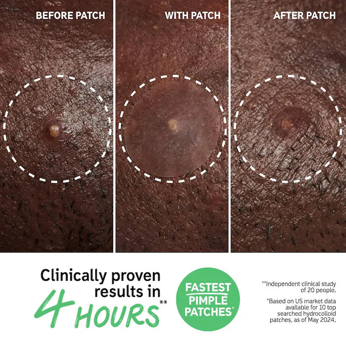 Hydrocolloid Invisible Pimple Patches