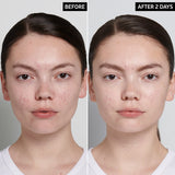 Succinic Acid Acne Treatment